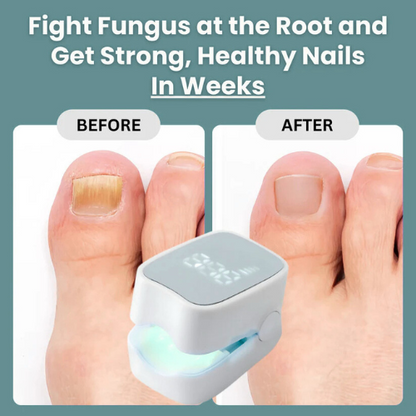 unicart™ - Nail Fungus Laser Device