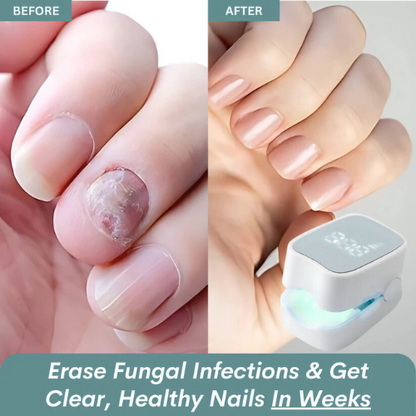 unicart™ - Nail Fungus Laser Device