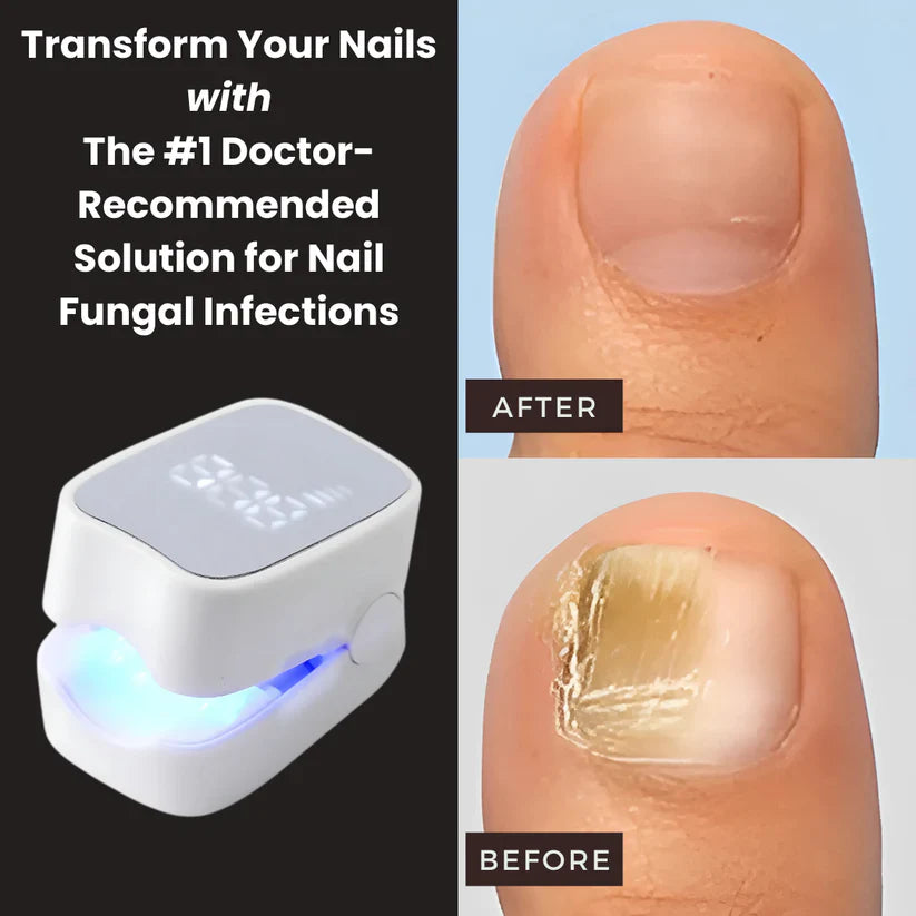 unicart™ - Nail Fungus Laser Device