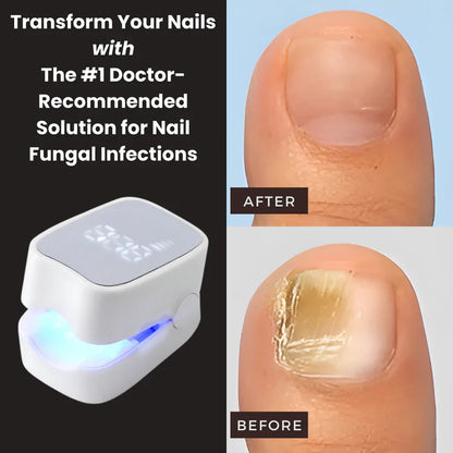 unicart™ - Nail Fungus Laser Device